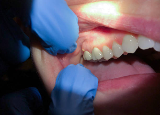 Best Emergency Treatment for Dental Infections or Abscesses in Sultan, WA